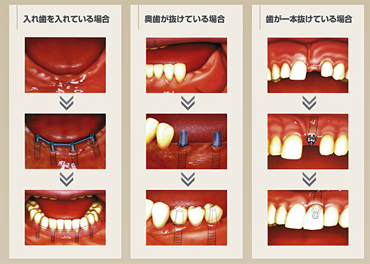 インプラント写真