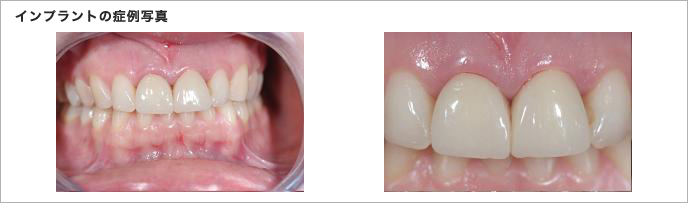 インプラントの症例写真